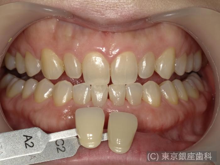 CASE01施術後