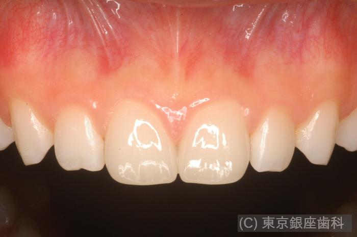 CASE01施術後
