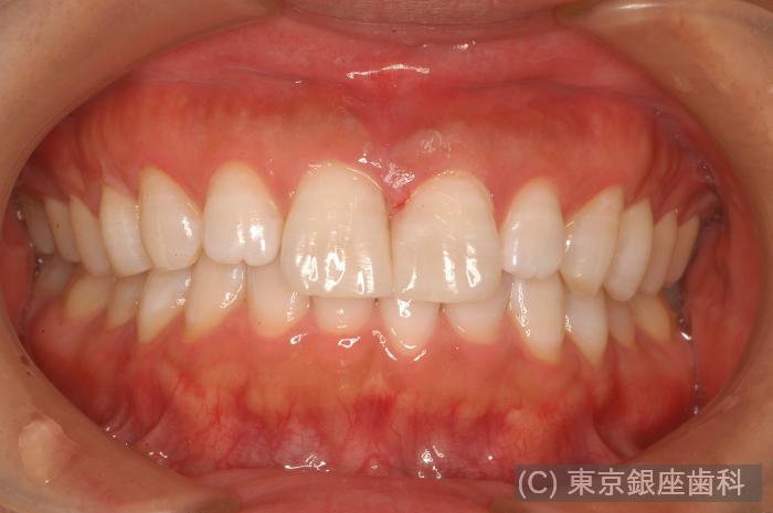 CASE01施術後